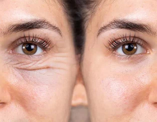 How Long Does It Take to Recover From Eyelid Surgery?