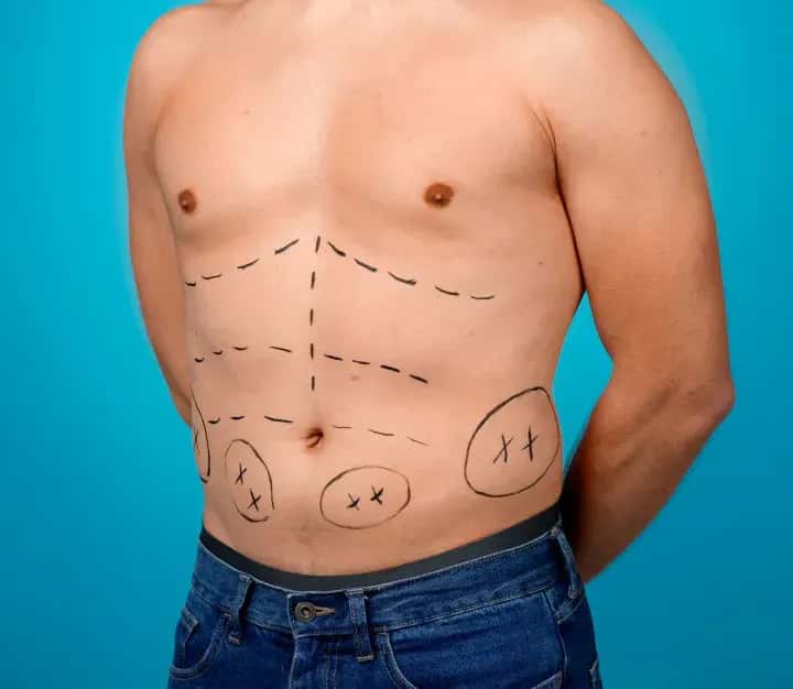 Tummy Tuck Recovery Time: What to Expect Week by Week