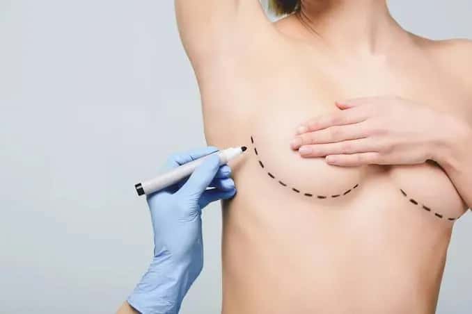 Breast Augmentation Recovery: What to Expect Week by Week